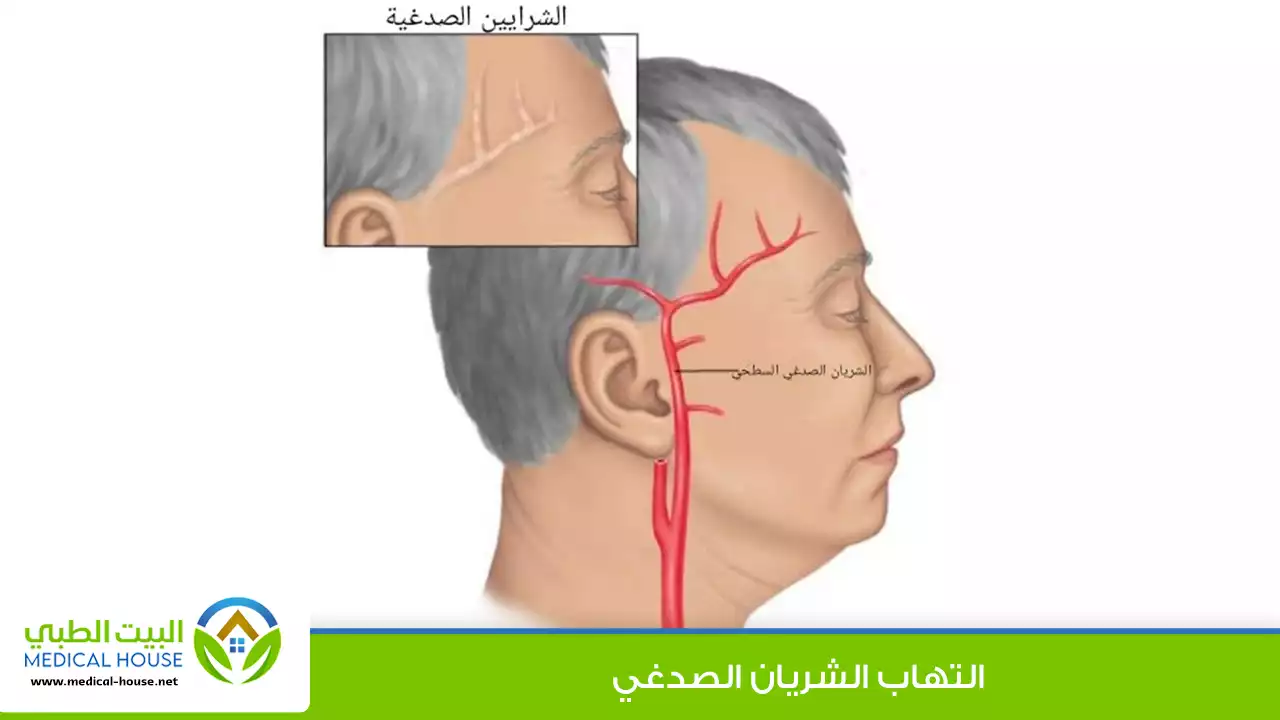 التهاب الشريان الصدغي – ما هو، أعراضه، أسبابه، المضاعفات والعلاج – البيت الطبي