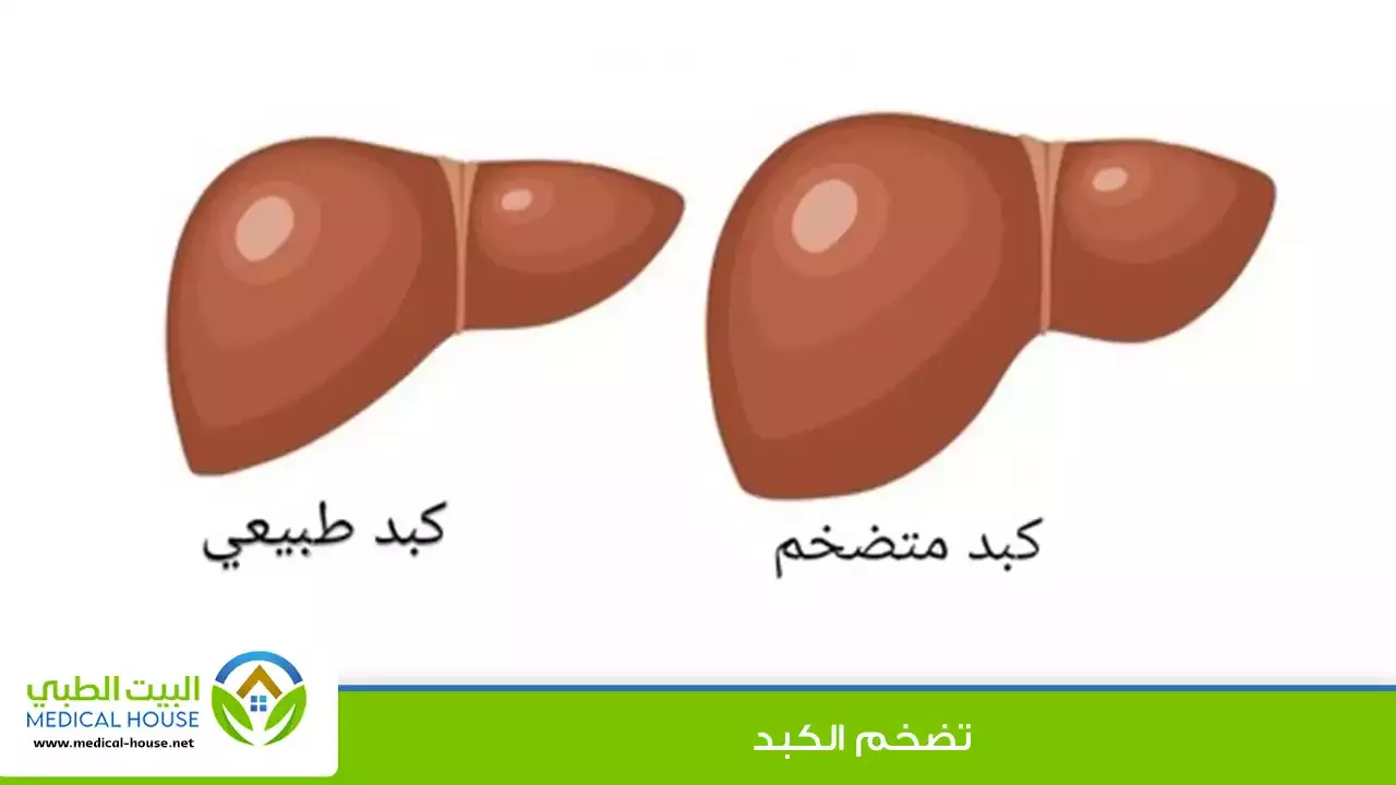 تضخم الكبد – الأسباب، الأعراض، التشخيص، العلاج وطرق الوقاية منه – البيت الطبي