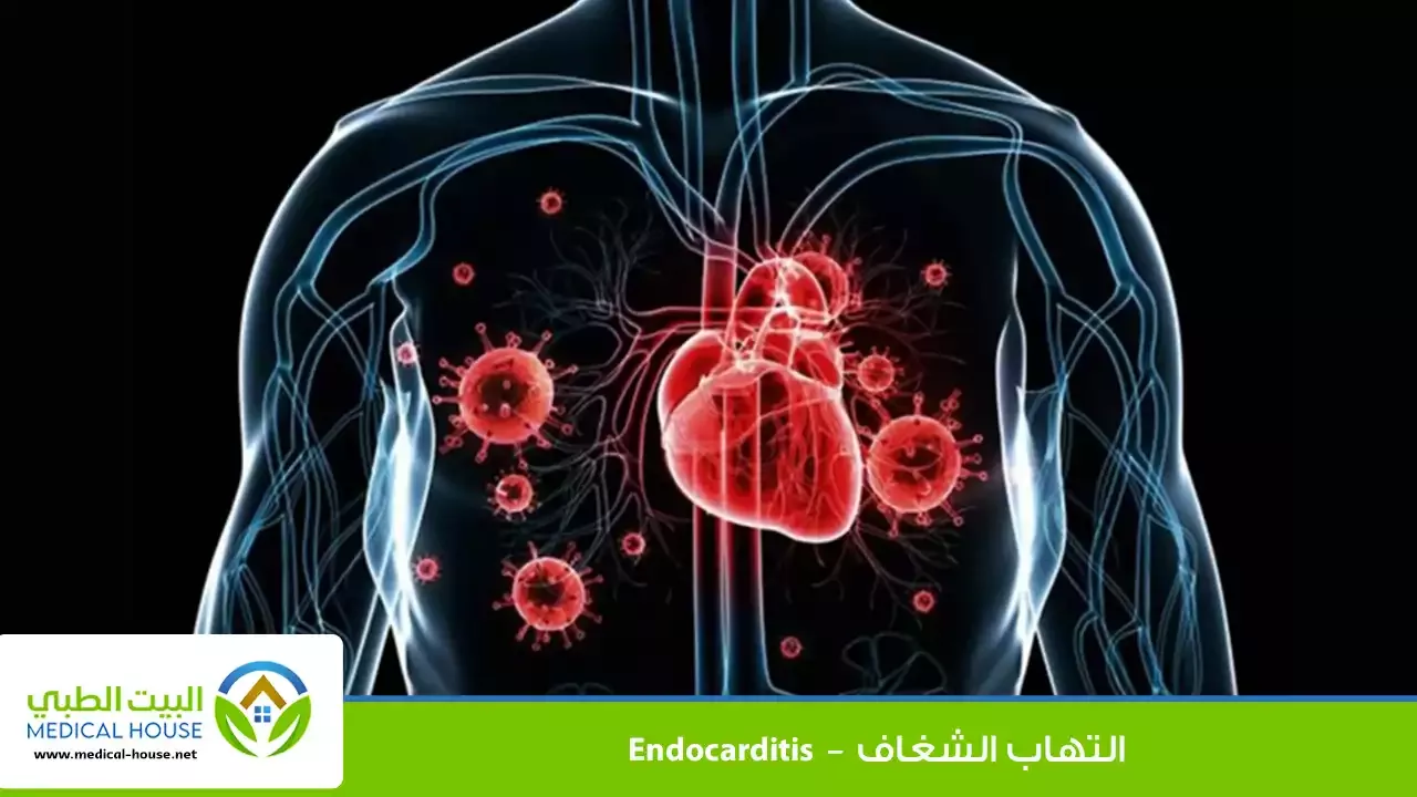 التهاب الشغاف – ما هو، أسبابه، أعراضه، المضاعفات والعلاج – البيت الطبي