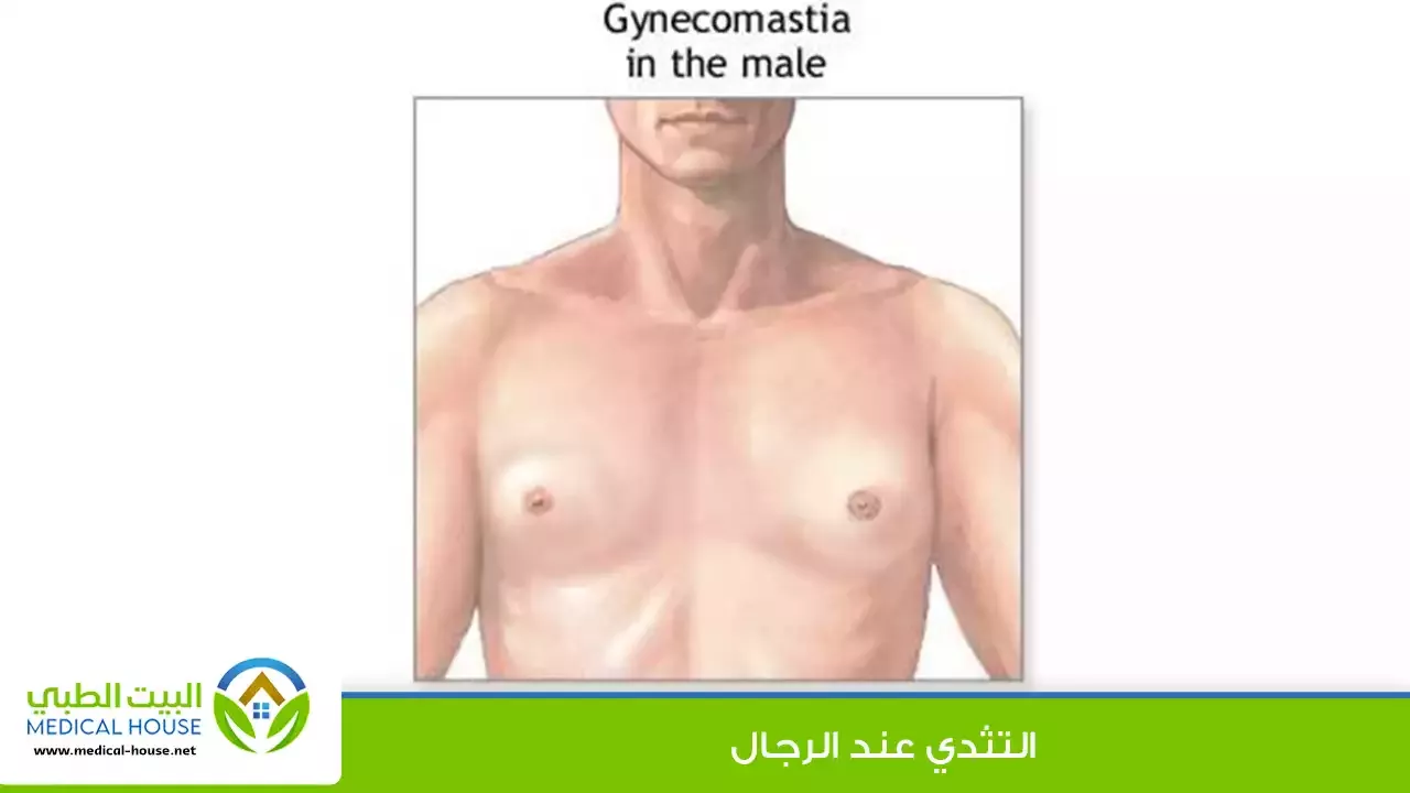 التثدي – ما هو، أسباب التثدي عند الرجال، أعراضه، تشخيصه، خيارات العلاج – البيت الطبي