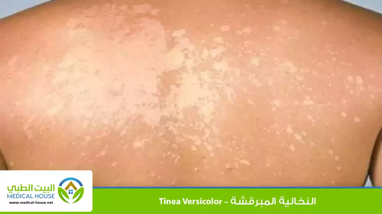 النخالية المبرقشة – ماهي، أسبابها، أعراضها، تشخيصها، العلاج والوقاية – البيت الطبي