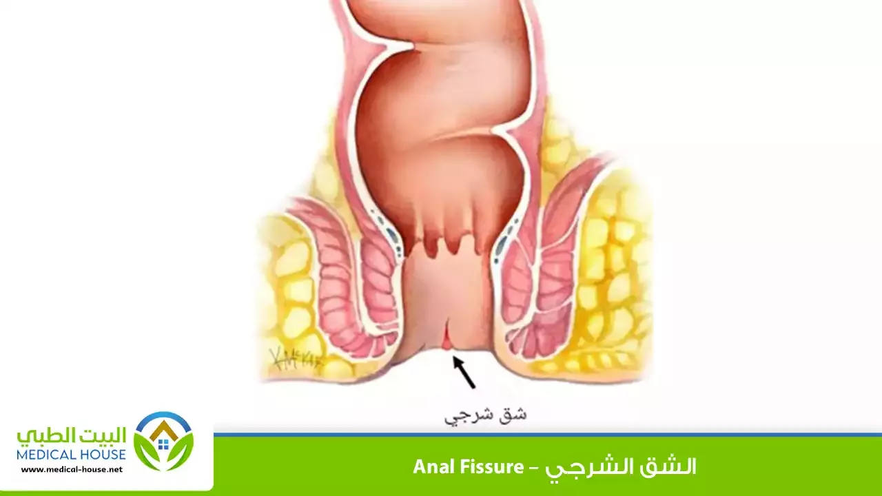 الشق الشرجي – ما هو، أسبابه، أعراضه، تشخيصه، العلاج والوقاية منه – البيت الطبي