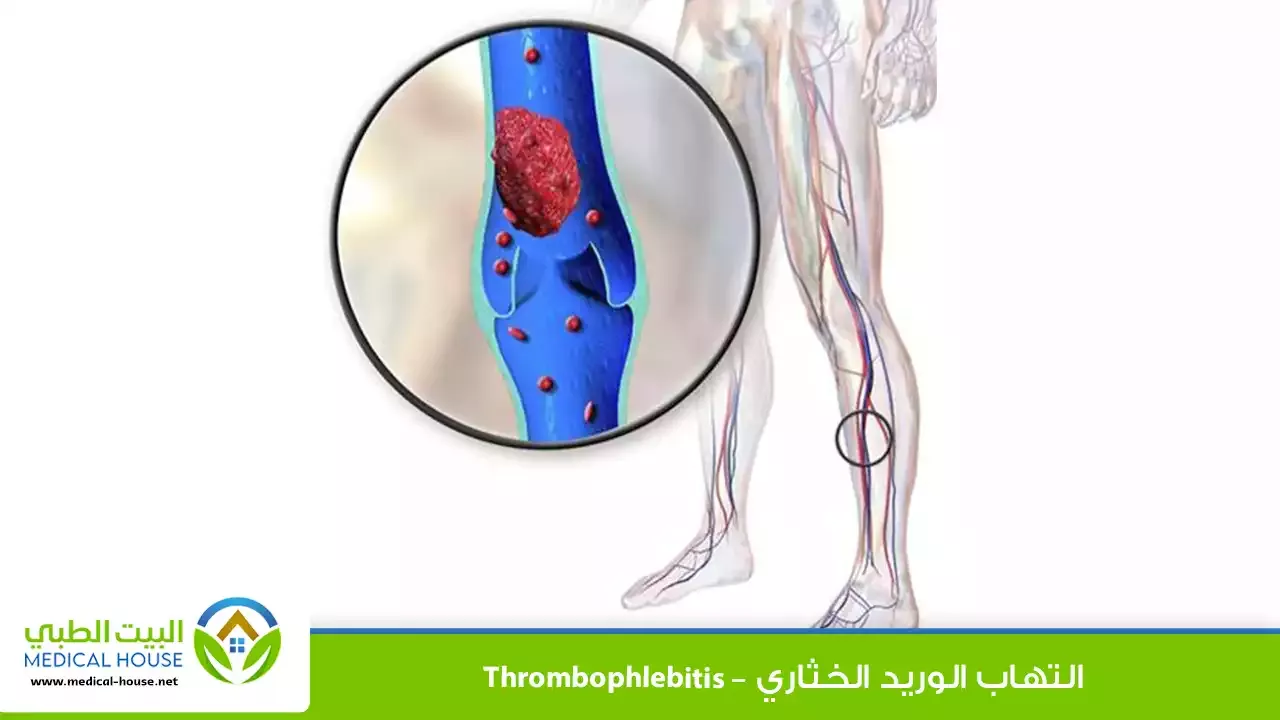 التهاب الوريد الخثاري – ما هو، أسبابه، أعراضه، التشخيص، العلاج والوقاية – البيت الطبي