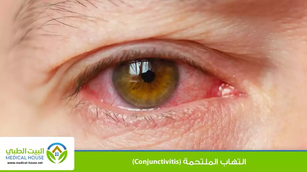 التهاب الملتحمة – ما هو، أسبابه، أعراضه، التشخيص، العلاج والوقاية، معلومات هامة – البيت الطبي