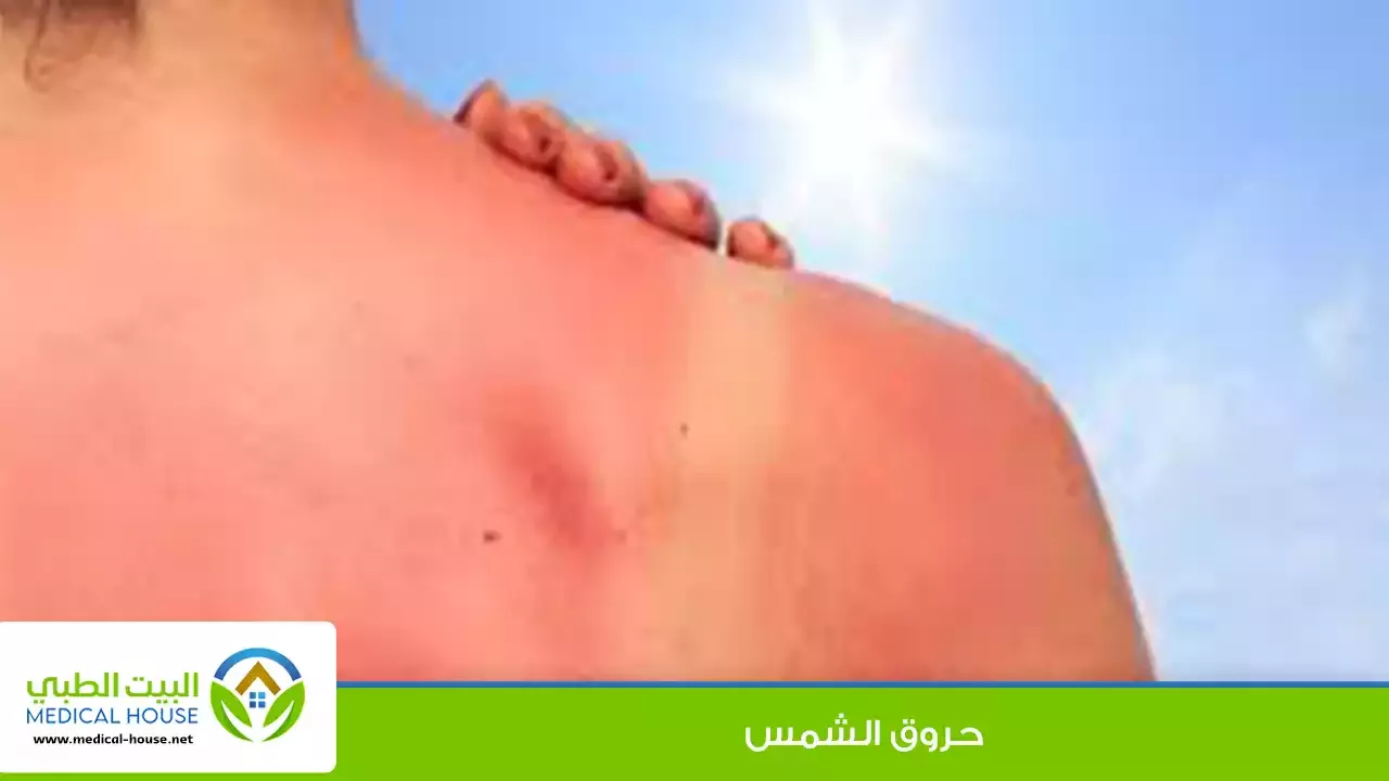 حروق الشمس – ماهي وكيف تتكون، العلاجات المنزلية لها وطرق منعها – البيت الطبي