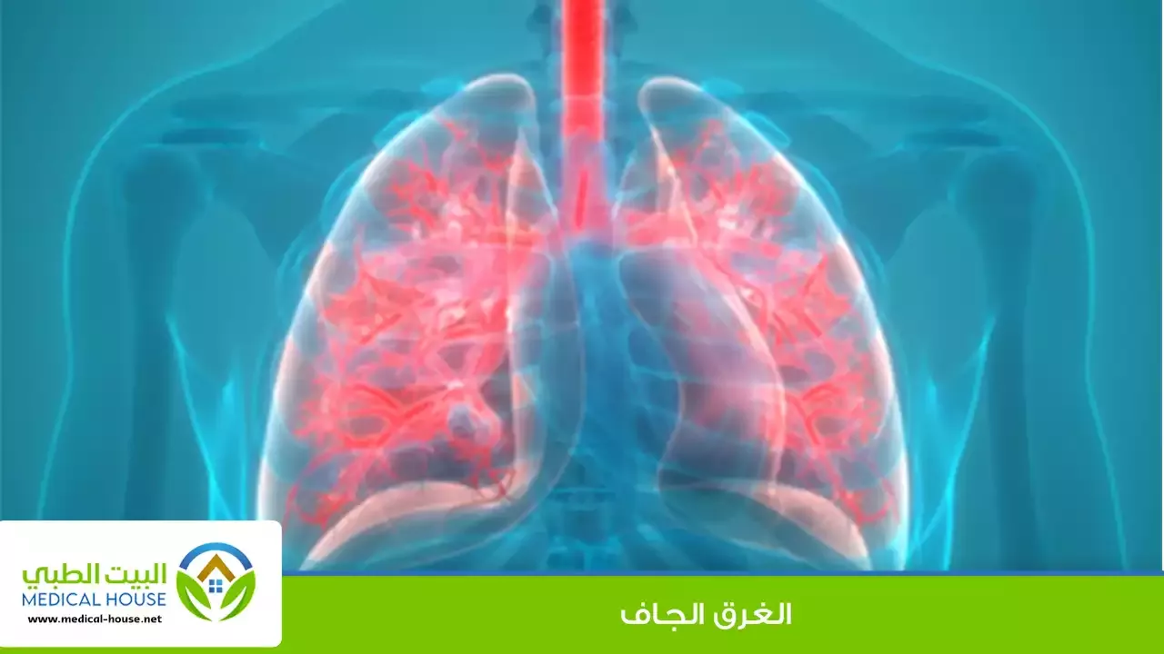 الغرق الجاف – ما هو؟، الأسباب، الأعراض، التشخيص، العلاج والوقاية منه – البيت الطبي