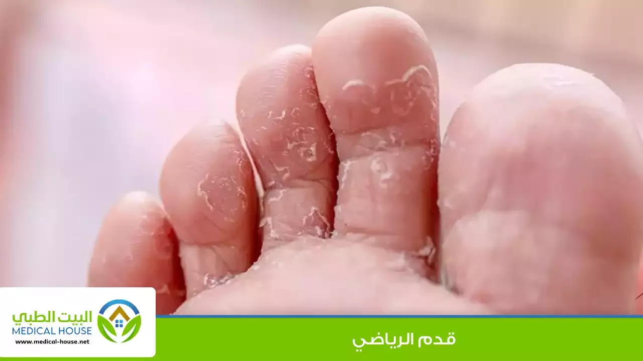 قدم الرياضي – الأسباب والأعراض، المضاعفات، التشخيص، العلاج والوقاية منه – البيت الطبي
