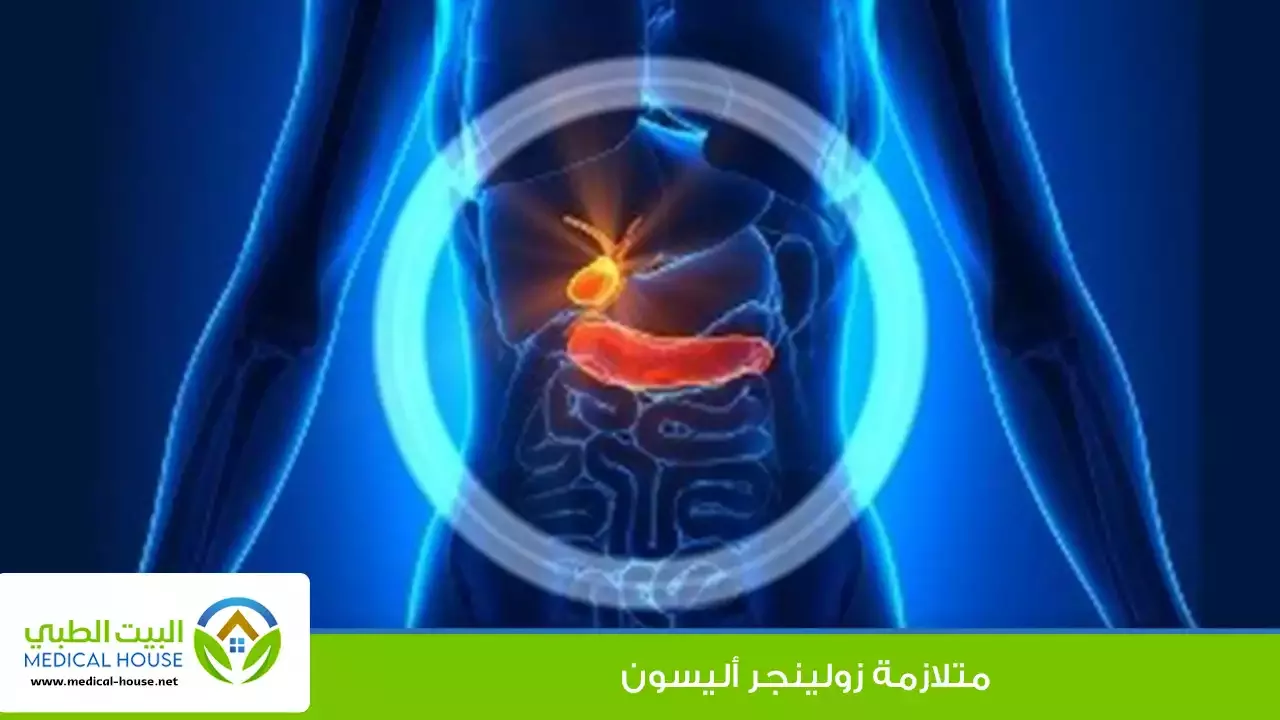 متلازمة زولينجر إليسون – تعريفها، الأسباب والأعراض، التشخيص والعلاج – البيت الطبي