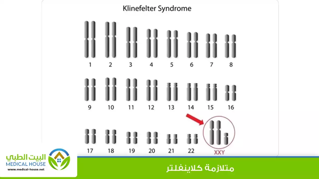 متلازمة كلاينفلتر – تعريفها، الأسباب والأعراض، التشخيص والعلاج – البيت الطبي