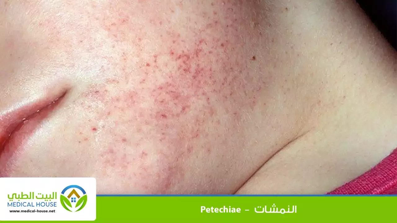 النمشات – ماهي؟، الأسباب والأعراض، الخيارات العلاجية والوقاية منها – البيت الطبي