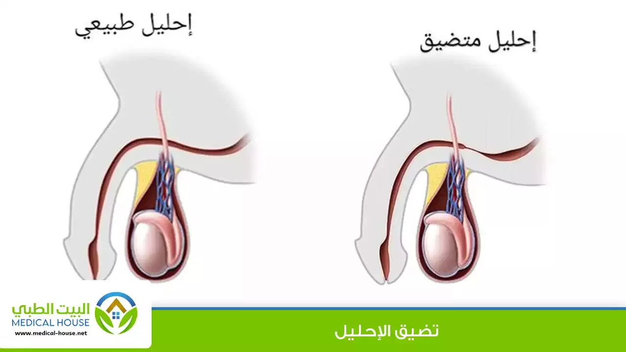 تضيق الإحليل – ما هو؟، الأسباب، الأعراض، التشخيص، طرق العلاج والوقاية – البيت الطبي