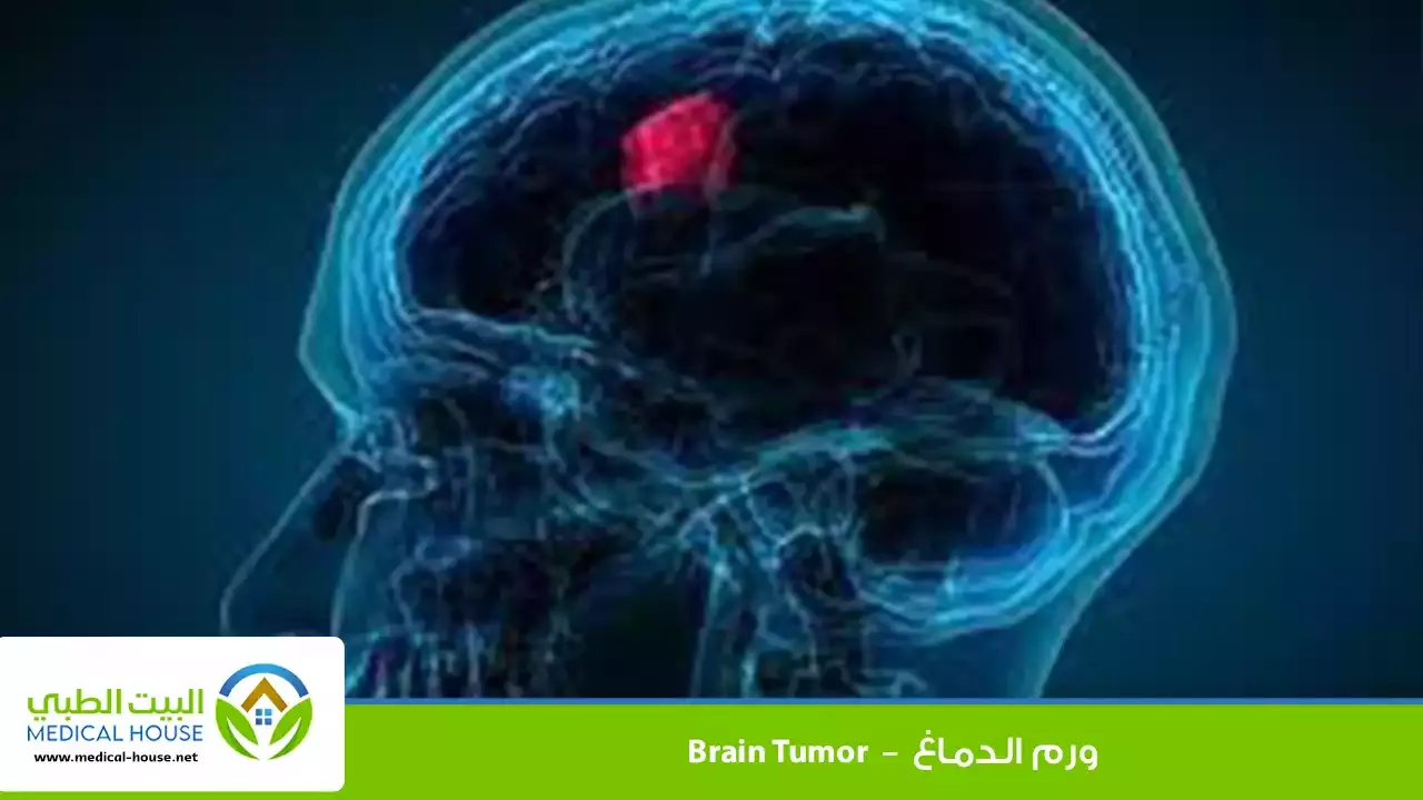 ورم الدماغ – تعريفه، أنواعه، الأعراض، التشخيص والعلاج – البيت الطبي