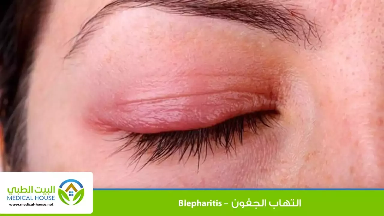 التهاب الجفون – ما هو، أعراضه، أسبابه، أنواعه، مضاعفاته، التشخيص، العلاج والوقاية – البيت الطبي