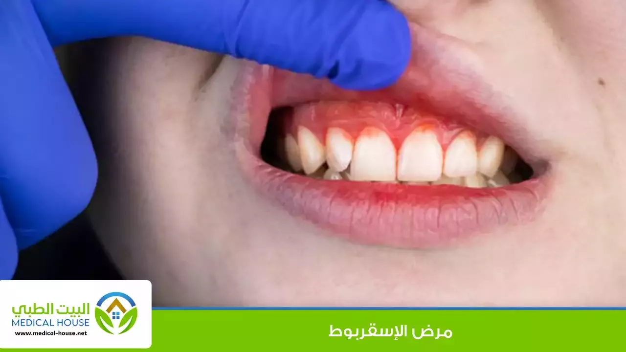 الإسقربوط – ما هو، علاماته، أسبابه، مضاعفاته، التشخيص، العلاج والوقاية – البيت الطبي