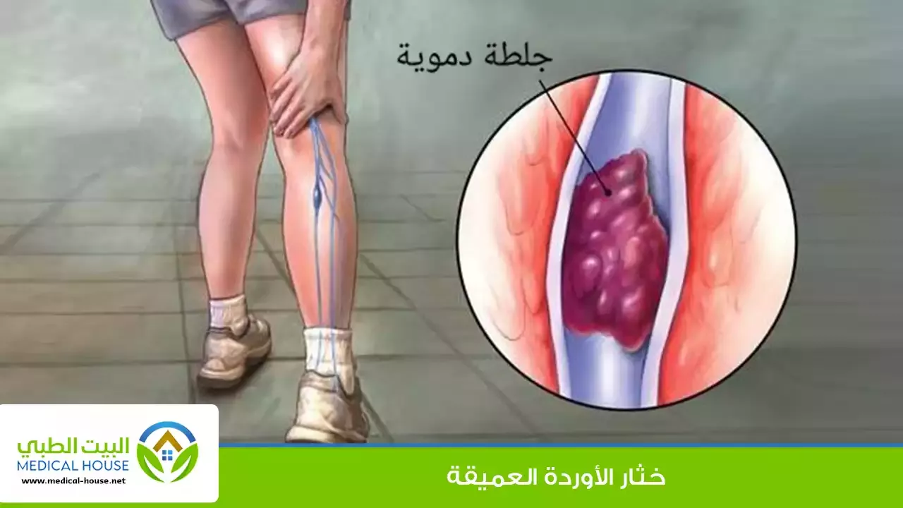 خثار الأوردة العميقة – الأسباب، الأعراض، التشخيص، المضاعفات، العلاج الوقاية – البيت الطبي