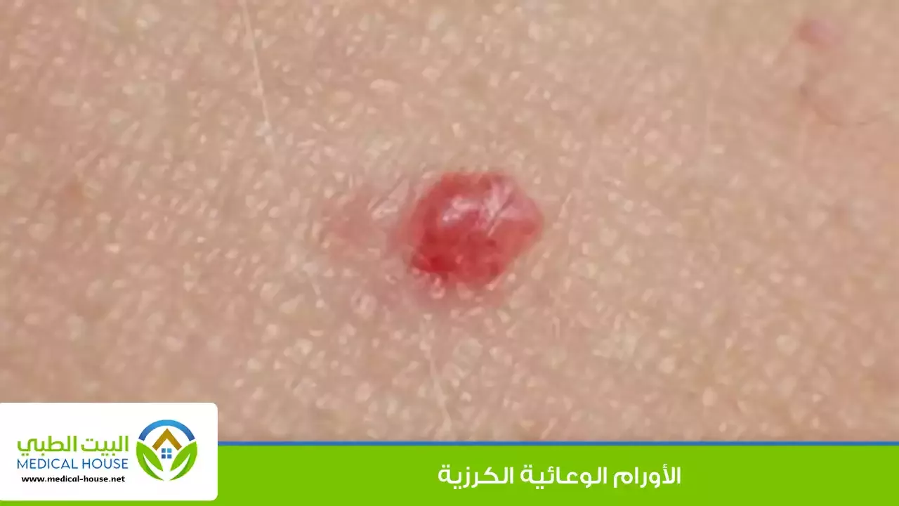 الورم الوعائي الكرزي – تعريفه، الأسباب، العلاج والوقاية منه – البيت الطبي