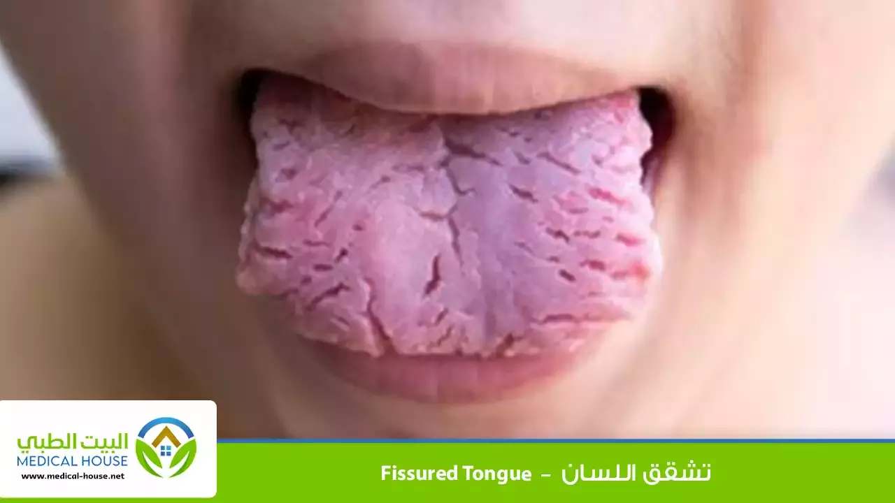 تشقق اللسان – تعريفه، متى يظهر؟، الأعراض والأسباب والعلاج – البيت الطبي