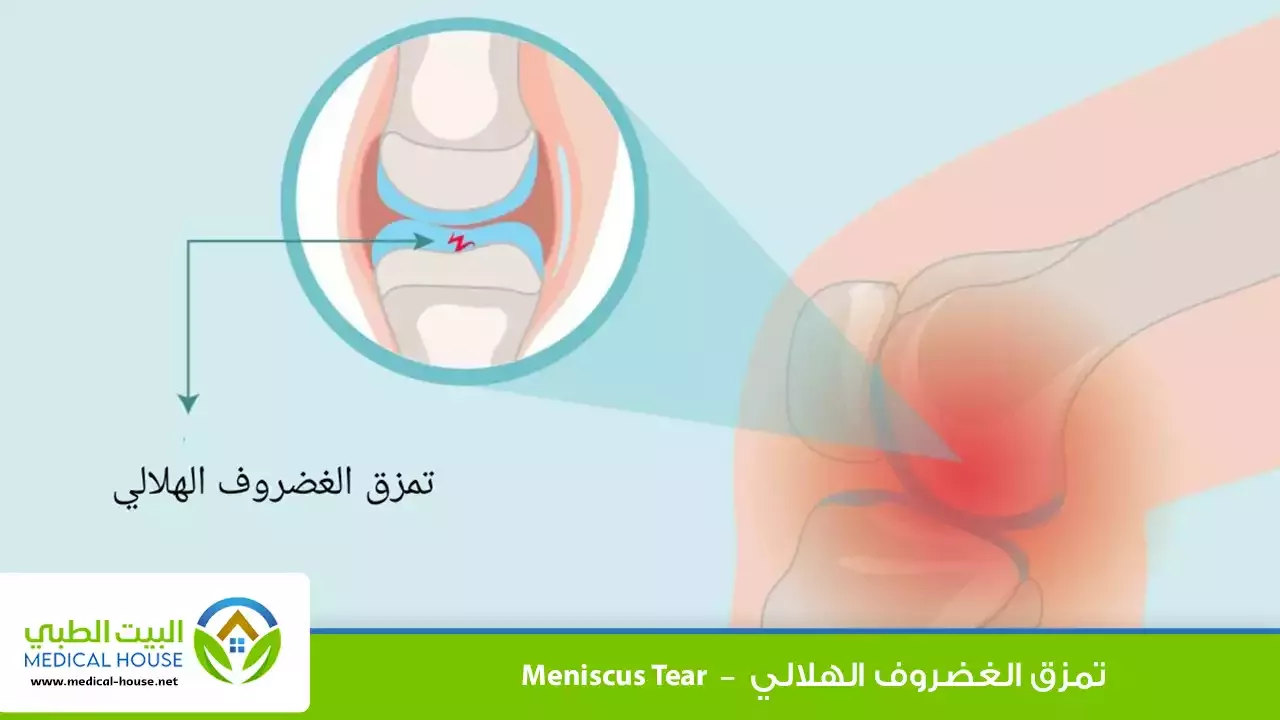 تمزق الغضروف الهلالي – الأسباب، الأعراض، التشخيص، العلاج والوقاية منه – البيت الطبي