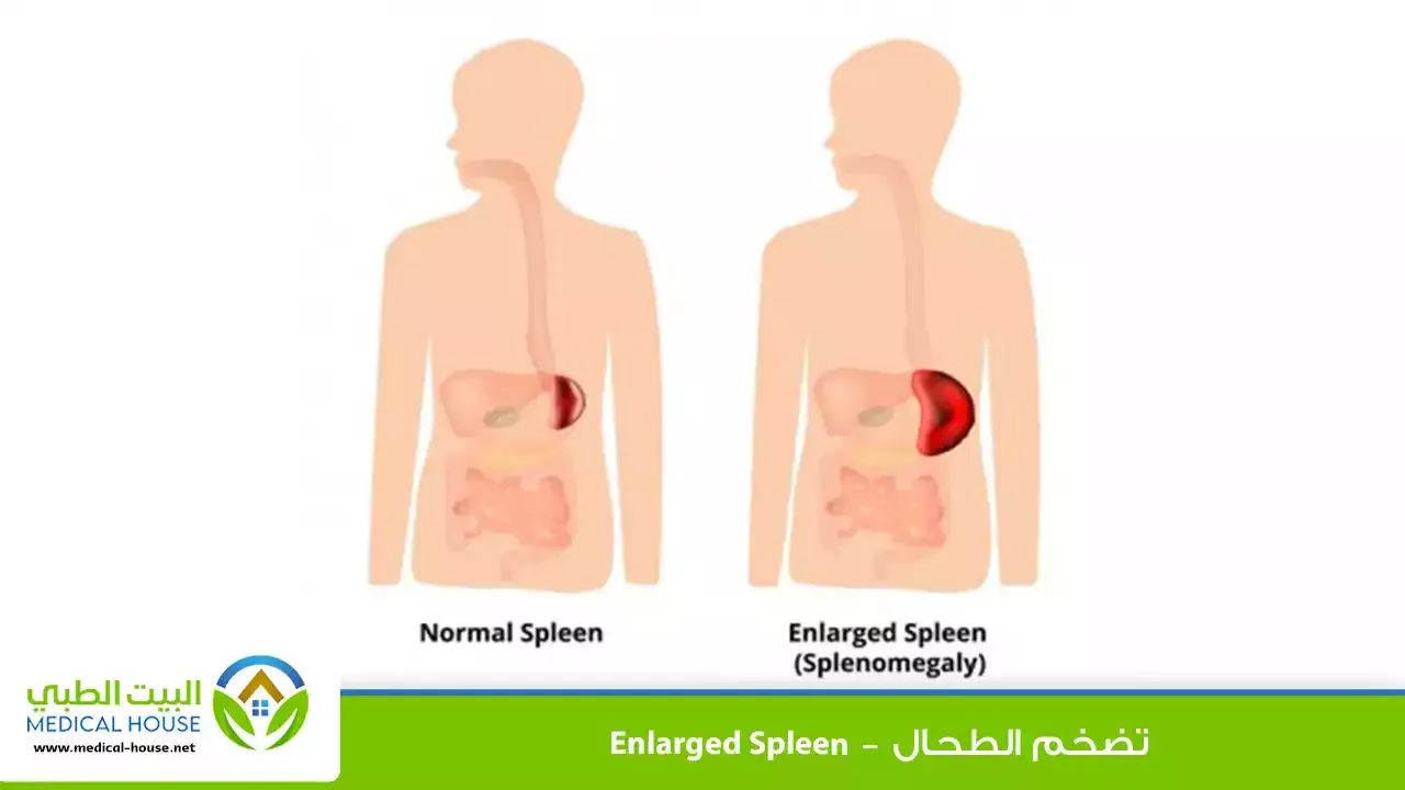 تضخم الطحال – الأسباب، الأعراض، التشخيص، العلاج، نصائح لمرضى تضخم الطحال – البيت الطبي