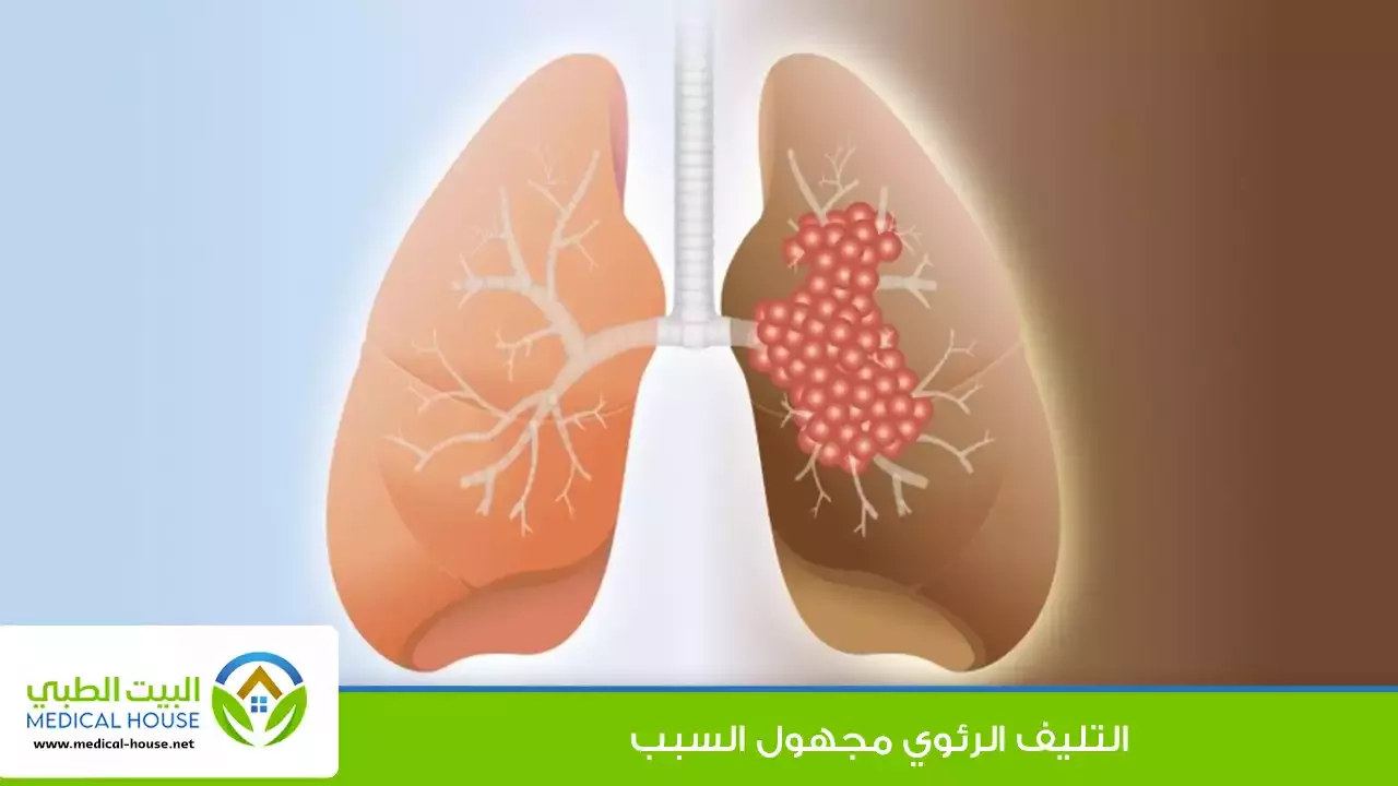 التليف الرئوي مجهول السبب – ما هو؟، الأعراض، المضاعفات، التشخيص والعلاج – البيت الطبي