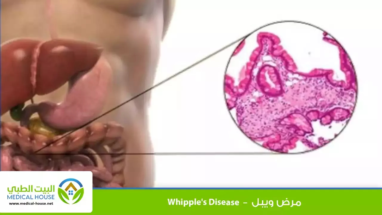 مرض ويبل – تعريفه، الأعراض، الأسباب، التشخيص، العلاج والوقاية منه – البيت الطبي