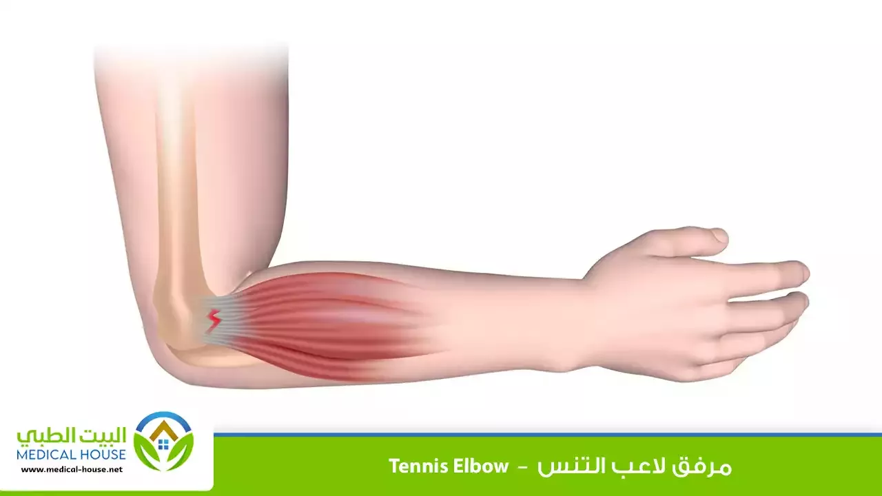 مرفق لاعب التنس – ما هو؟، الأسباب، الأعراض، التشخيص، العلاج والوقاية – البيت الطبي