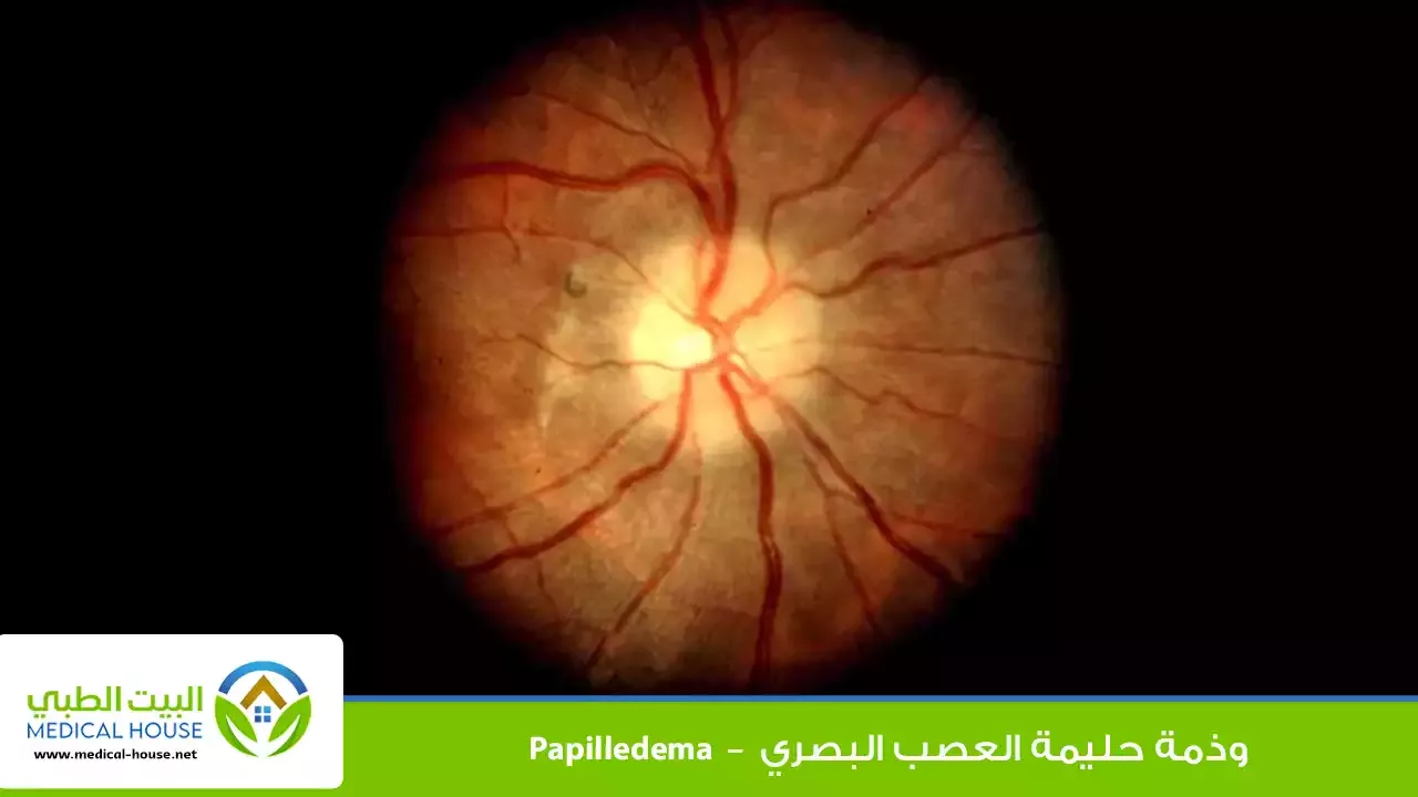 وذمة حليمة العصب البصري – ماهي؟، الأسباب، الأعراض، التشخيص والعلاج – البيت الطبي