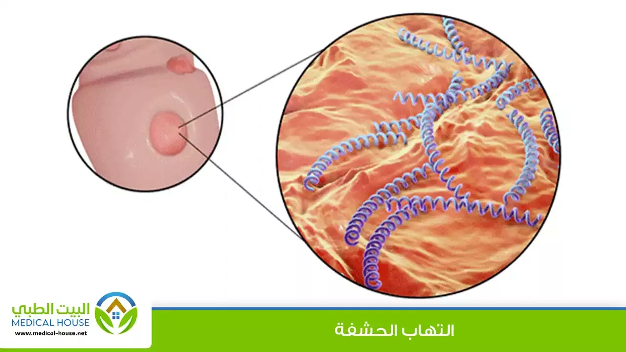 التهاب الحشفة – ما هو؟، أسبابه، أنواعه، أعراضه، التشخيص، العلاج والوقاية منه – البيت الطبي