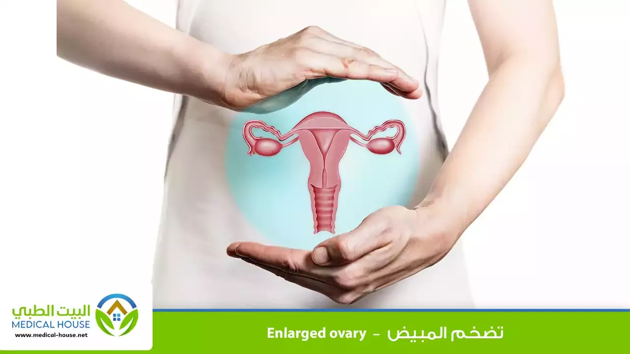 تضخم المبيض – ما هو، أعراضه، أسبابه، خيارات العلاج والمضاعفات – البيت الطبي