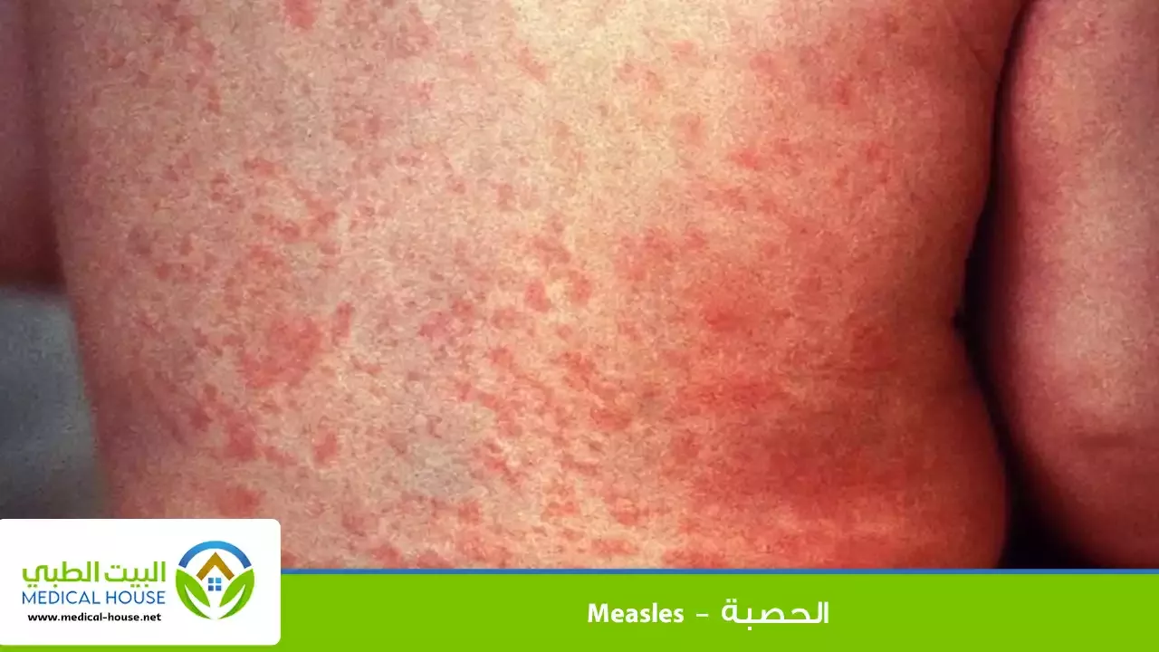 الحصبة  _ماهي ،اسبابها ،اعراضها ،علاجها والوقاية منها ....  البيت الطبي