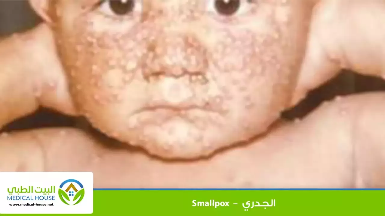 الجدري – ما هو، أنواعه، أعراضه، التشخيص، العلاج والوقاية منه – البيت الطبي