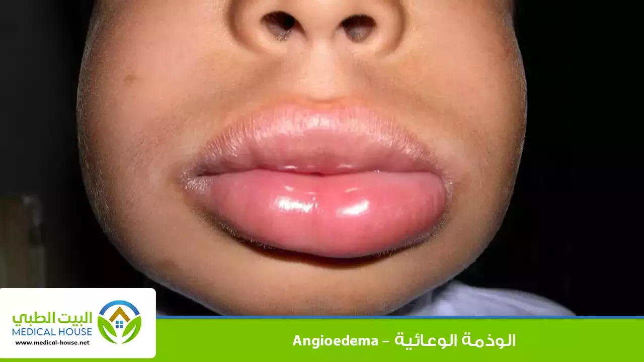 الوذمة الوعائية – ماهي، أنواعها، أسبابها، أعراضها ومضاعفاتها، التشخيص، العلاج الوقاية