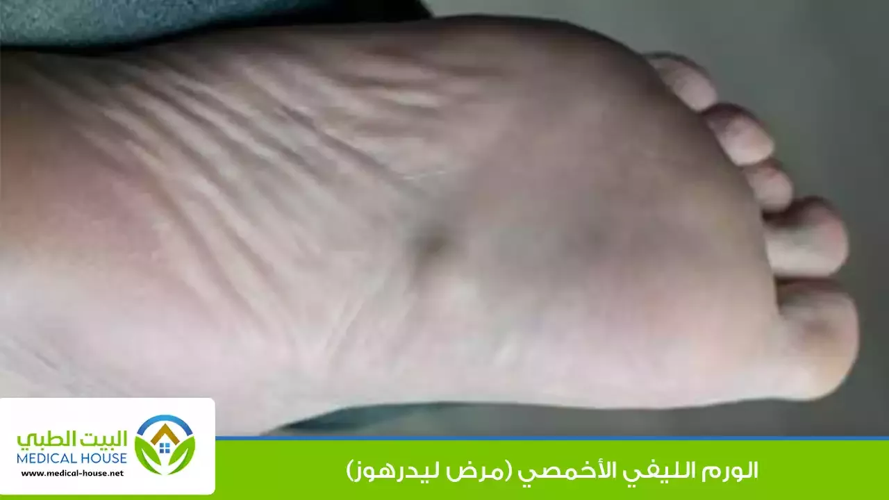الورم الليفي الأخمصي – ما هو، أعراضه ومضاعفاته، أسبابه، تشخيصه، العلاج والوقاية