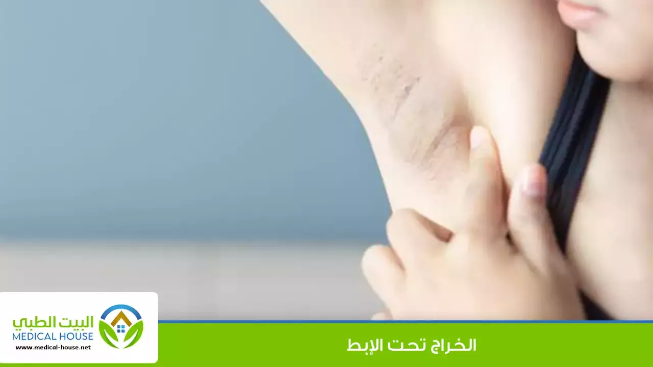 خراج تحت الإبط - العوامل المساهمة لتشكله، تشخيصه، الوقاية، العلاج الجراحي والمنزلي له