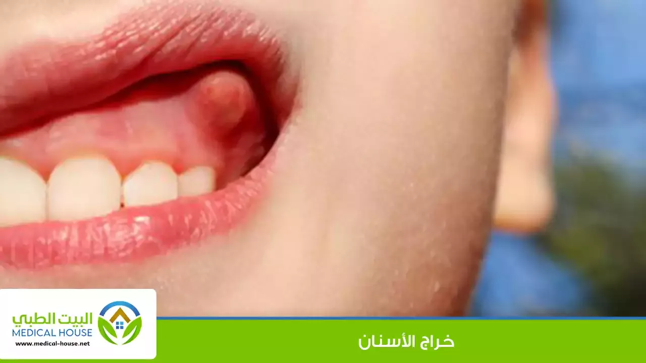 خراج الأسنان - ما هو، أنواعه، طرق علاجه وتهدئة أعراضه، والحالات التي تستدعي زيارة الطبيب