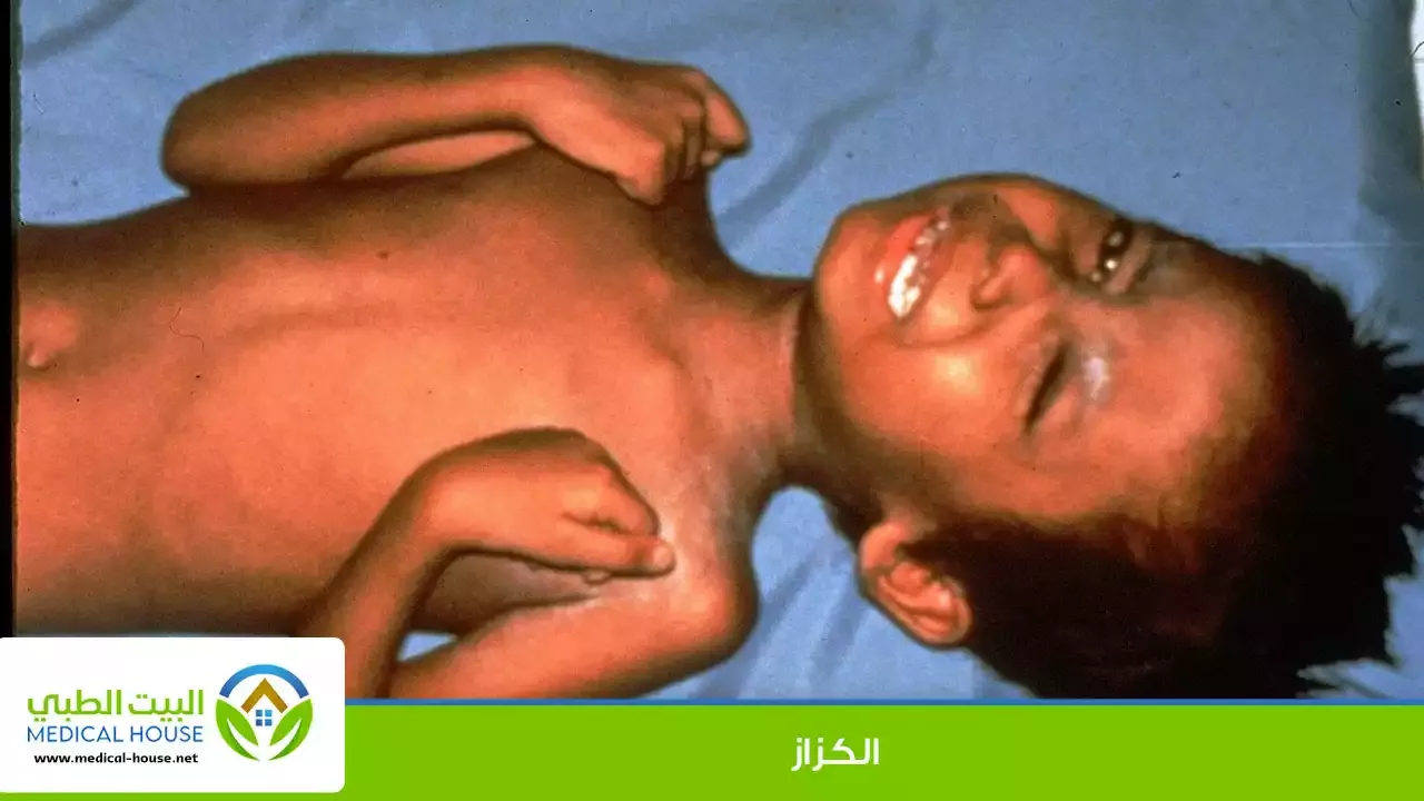 الكزاز ـ ماهو ؟ الاسباب وطرق العلاج والمضاعفات ـ د سارة ابراهيم ـ البيت الطبي