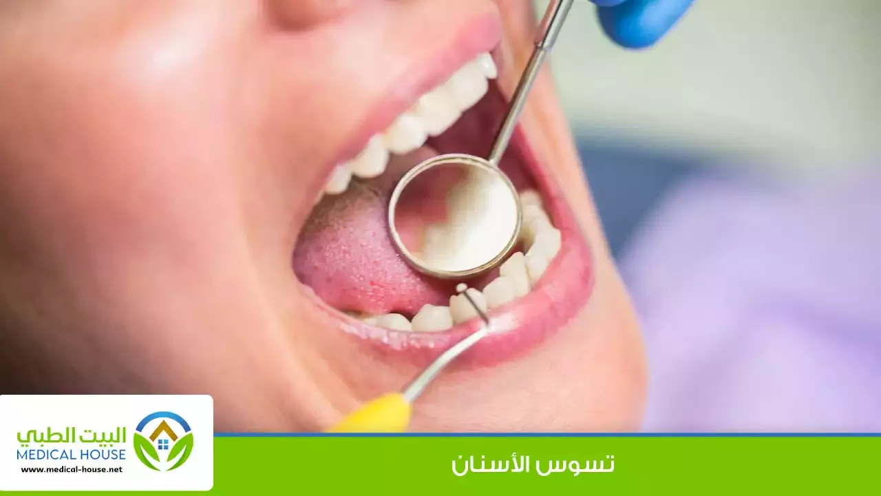 تسوس الأسنان ـ الاسباب والاعراض وطرق الوقاية ـ د محمد النمر ـ البيت الطبي