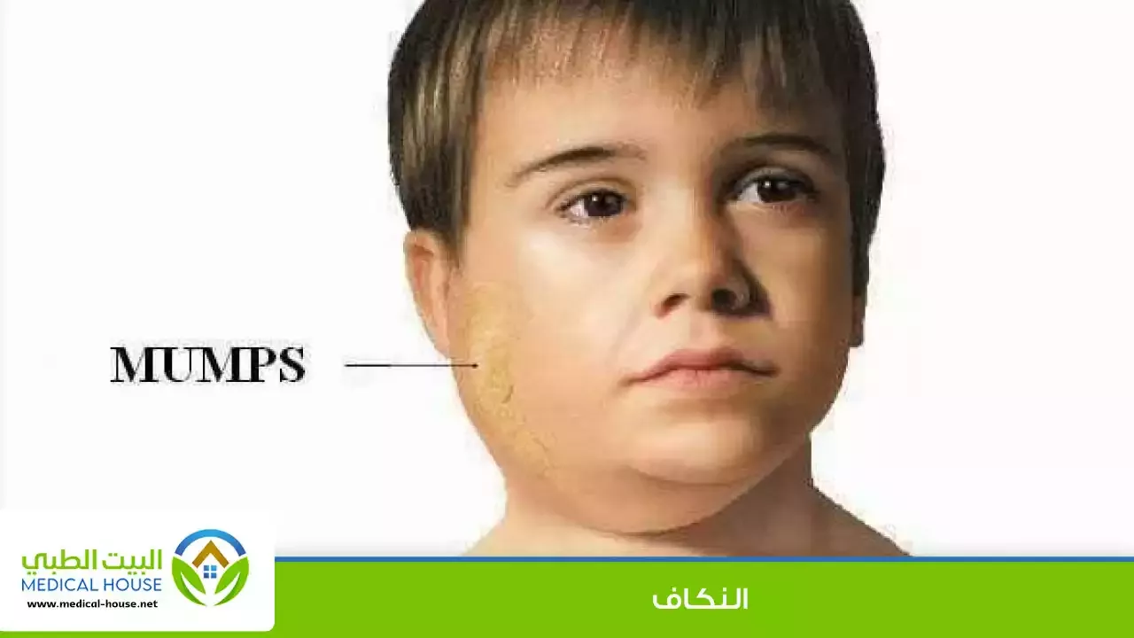 التهاب الغدة النكافية ( النكاف ) الأسباب والاعراض وطرق العلاج ـ د سارة ابراهيم ـ البيت الطبي