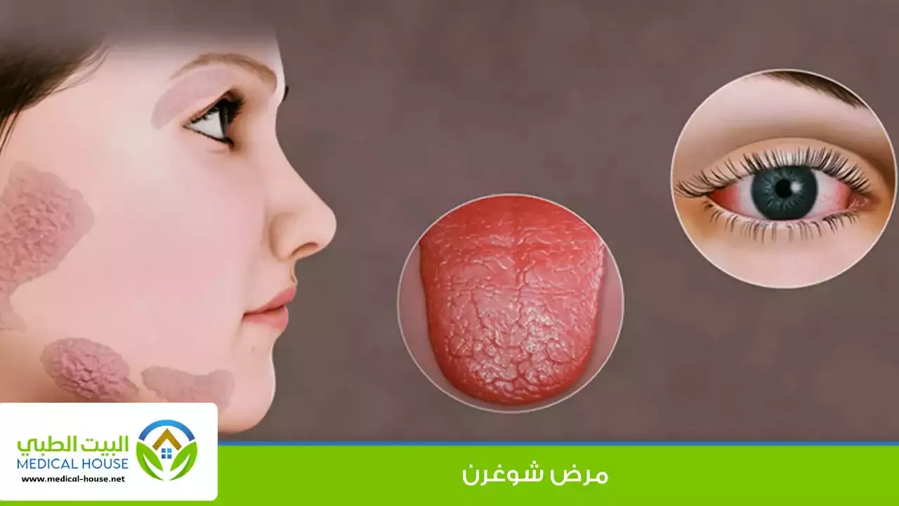 متلازمة شوغرن الأعراض والاسباب وطرق العلاج ـ د سارة ابراهيم ـ البيت الطبي