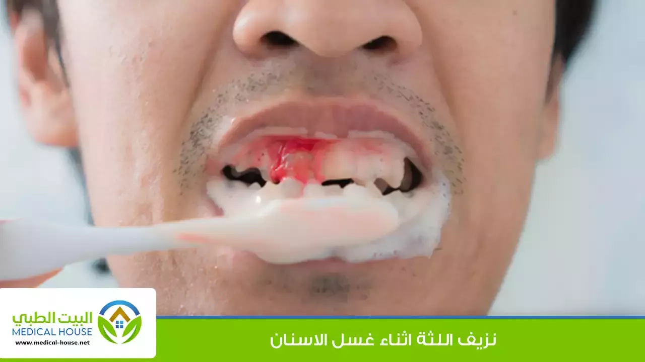 نزيف اللثة اثناء غسل الاسنان ـ الاسباب وطرق العلاج د محمد النمر ـ البيت الطبي