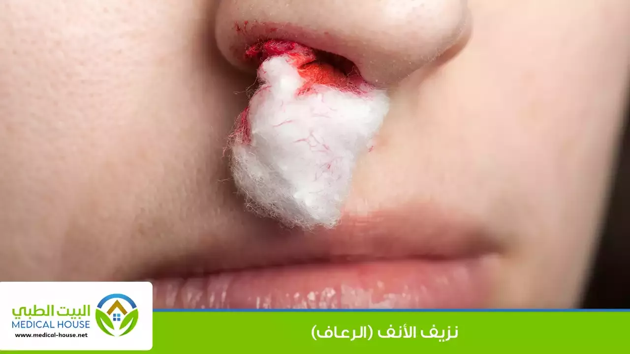 الرعاف - من هم الأكثر عرضة للرعاف، أسبابه، تشخيصه، العلاج طبياً ومنزلياً، والوقاية منه