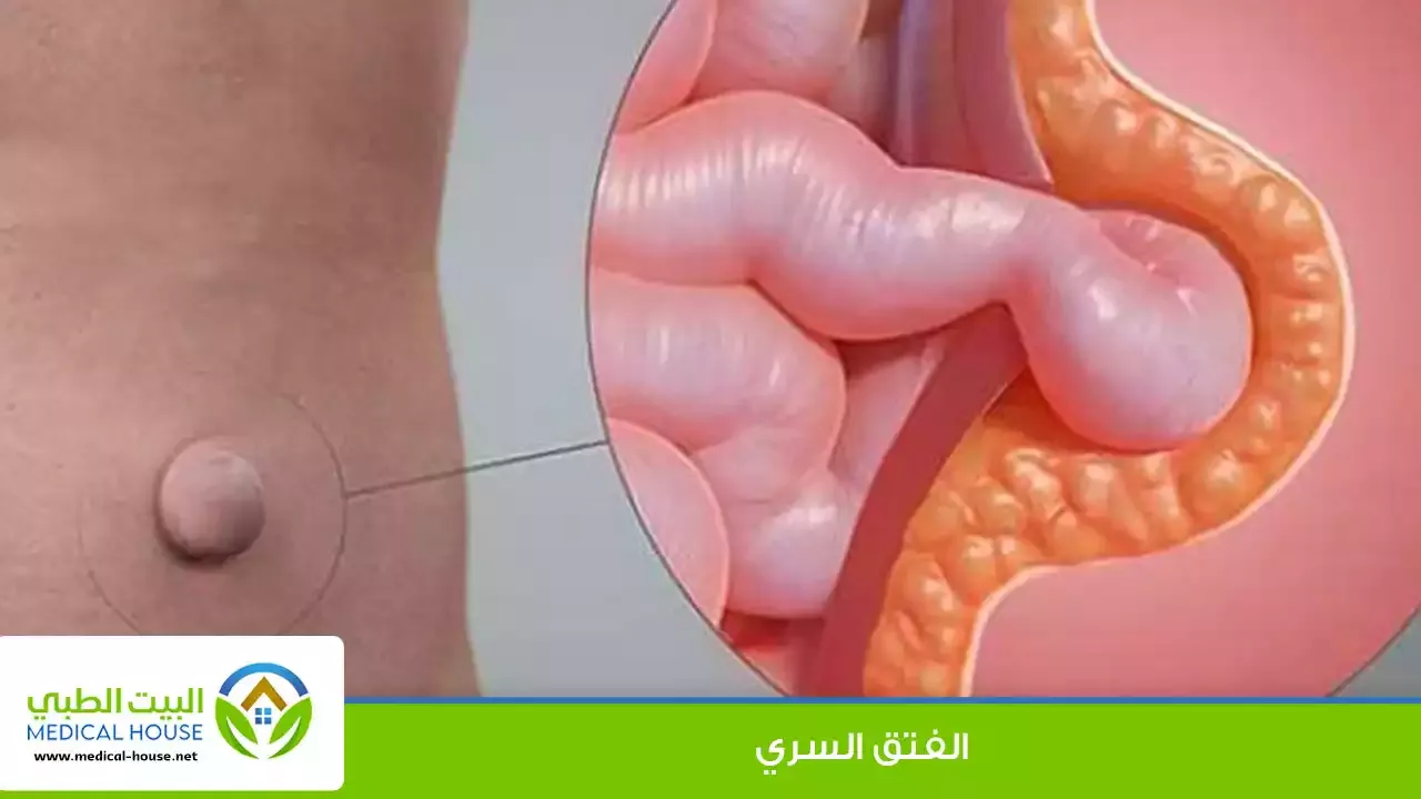الفتق السري ـ الاسباب و الاعراض وطرق العلاج ـ شريف محمد ـ البيت الطبي