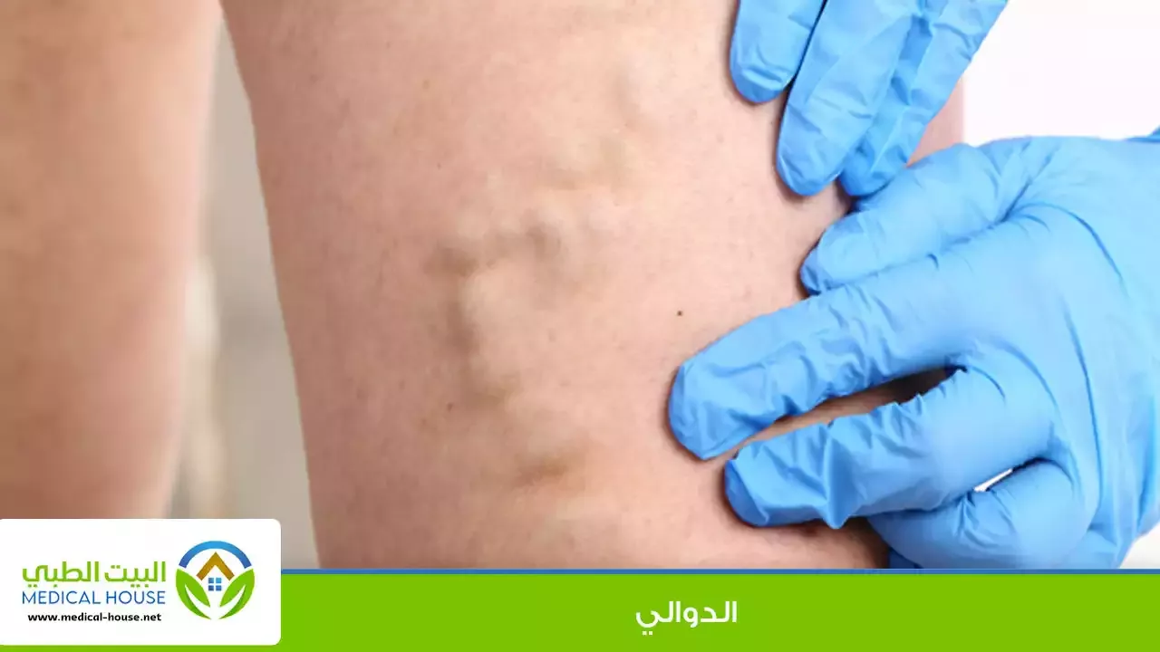 الدوالي الوريدية ـ كل ما تحتاج لمعرفته (الاسباب ـ الوقاية ـ وطرق العلاج) ـ البيت الطبي
