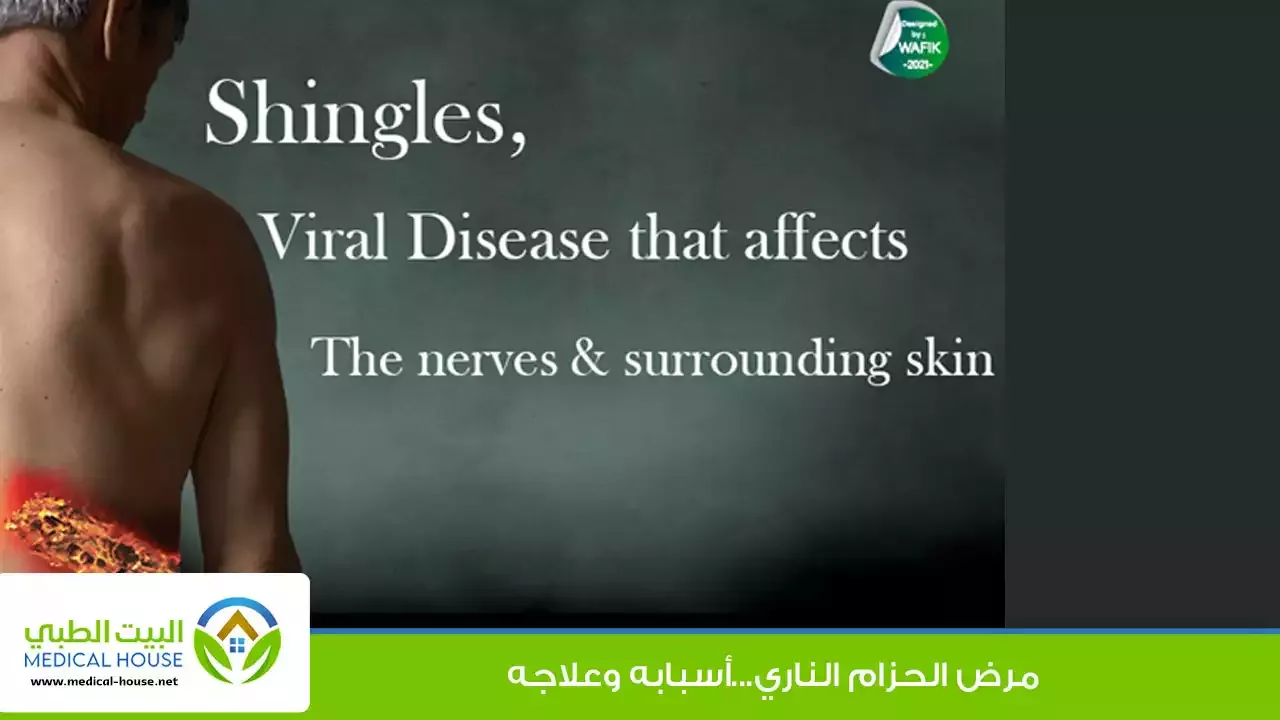 الحزام الناري أو القوباء المنطقية أعراضه أسبابه وعلاجه وكل مايخص هذا المرض - البيت الطبي