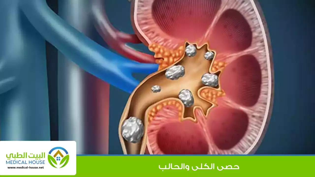حصوات الكلى والحالب - أسبابها، أعراضها، التشخيص، طرق العلاج والوقاية - البيت الطبي