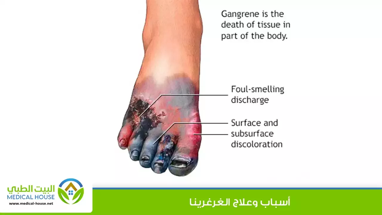 الغرغرينا الأسباب والعلاج - ما هي أنواعها، أعراضها وتشخيصها، طرق الوقاية والعلاج - البيت الطبي