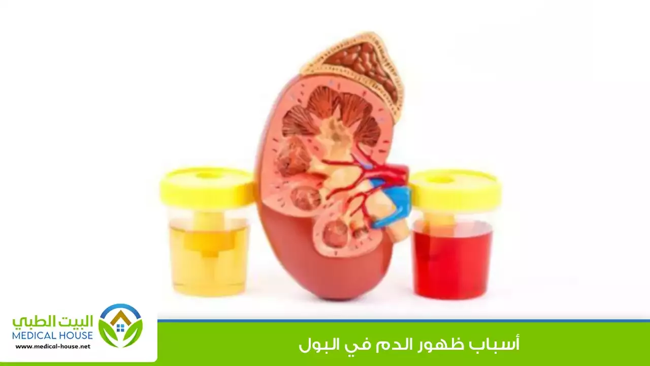الدم في البول - أنواعه، أسباب ظهوره، كيفية تشخيصه وعلاج مشكلة ظهوره - البيت الطبي