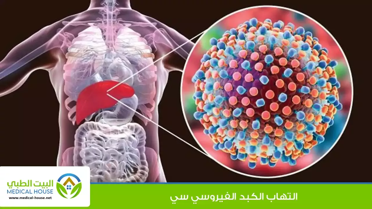 التهاب الكبد سي - أعراض الإصابة بالتهاب الكبد الفيروسي سي والوقاية منه - البيت الطبي