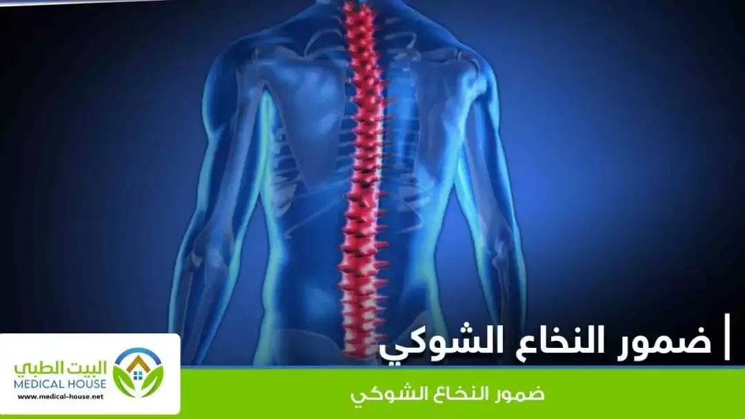 -ضمور النخاع الشوكي ،واسبابه ومضاعفاته والوقايه منه