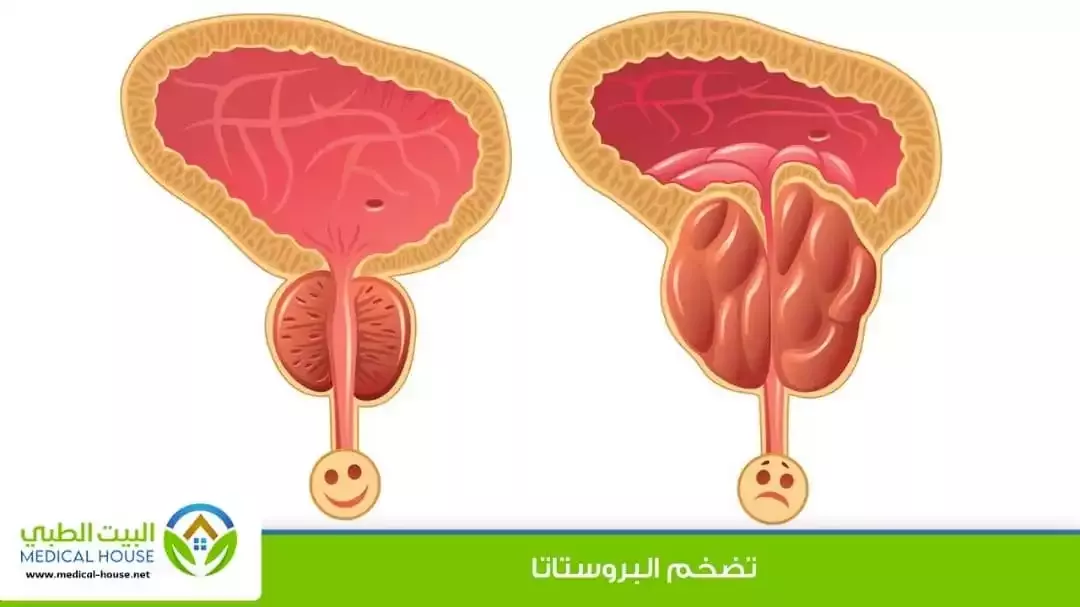البروستاتا والانتصاب – ما هما، أسبابهما، العلاقة بينهما، مشاكلهما، التشخيص والعلاج – البيت الطبي